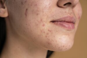 confident-young-woman-with-acne-close-up (1)