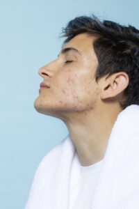 side-view-man-with-skin-problems